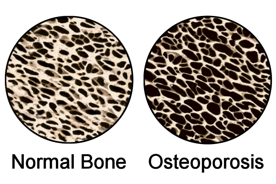 Comparison of normal bones and bones with osteoporosis