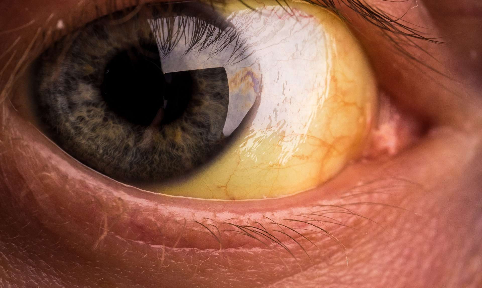 yellow eyeballs causes